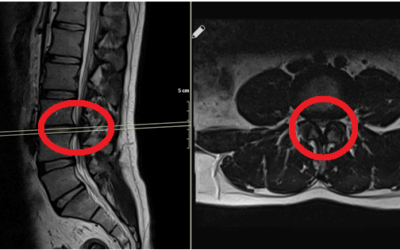 Belde Omurilik Kanalı Daralması (Spinal Stenoz)