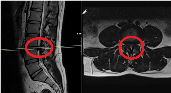 Belde Omurilik Kanalı Daralması (Spinal Stenoz)