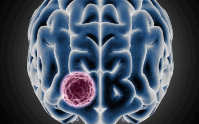 Beyin Tümörü 