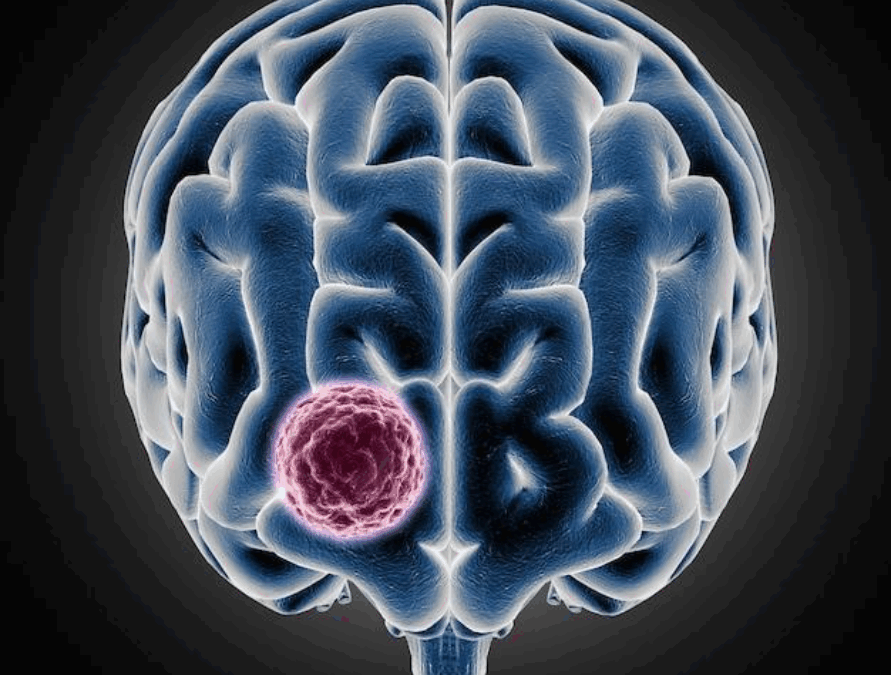 Beyin Tümörü 