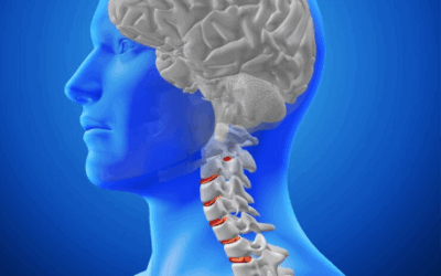 Beyincik Sarkması (Chiari Sendromu) 