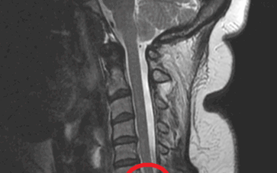 Boyun Fıtığı (Servikal Disk Hernisi) 