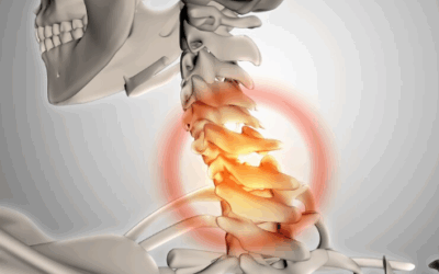 Boyunda Omurilik Kanalı Daralması (Servikal Spinal Stenoz) 
