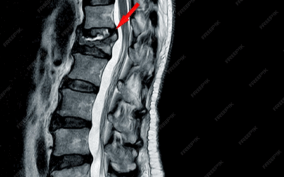 Omurga Kırıkları (Vertebra Fraktürleri) 