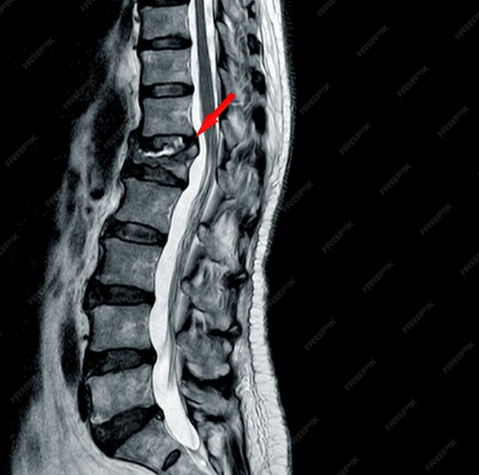 Omurga Kırıkları (Vertebra Fraktürleri) 